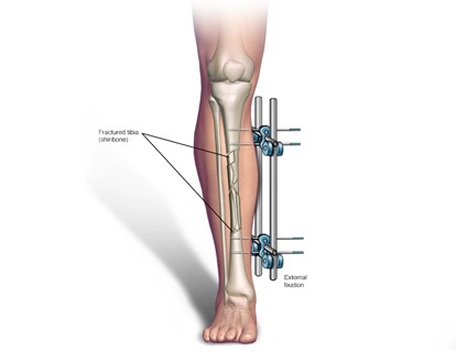 fracture treatment