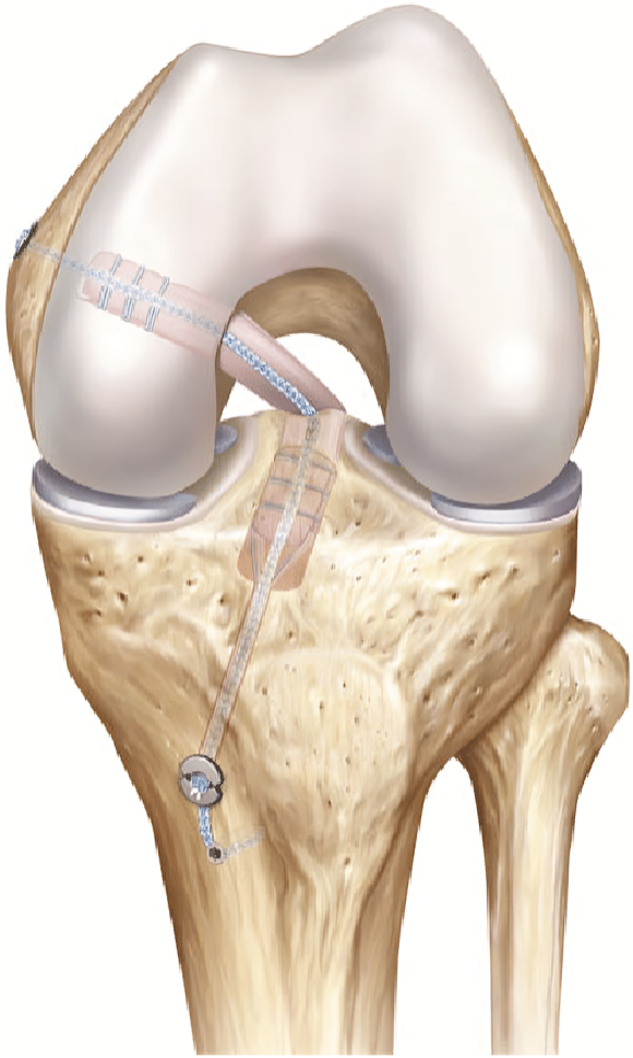 llustration of final all inside posterior cruciate ligament reconstruction with (1)